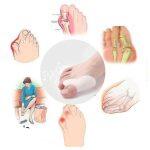 Νάρθηκας από Σιλικόνη για Διόρθωση των Δακτύλων του Ποδιού - Image 6